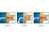 Lavaggio spray per orecchio Otoclear