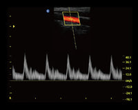 Ecografo Color-Doppler portatile CHISON ECO5 - senza sonde