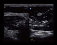 Ecografo Color-Doppler portatile CHISON ECO5 - senza sonde