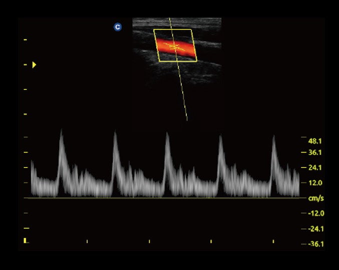 Ecografo Color-Doppler portatile CHISON ECO5 - senza sonde