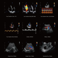 Ecografo Color-Doppler carrellato CHISON QBit5 - senza sonde