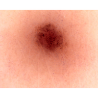 Dermatoscopio Mic-Fi - WI-FI/USB con filtro polarizzato