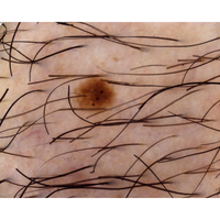 Dermatoscopio Mic-Fi - WI-FI/USB con filtro polarizzato