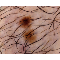 Dermatoscopio Mic-Fi - WI-FI/USB con filtro polarizzato