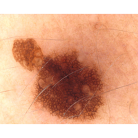 Dermatoscopio Mic-Fi - WI-FI/USB con filtro polarizzato