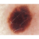 Dermatoscopio Mic-Fi - WI-FI/USB con filtro polarizzato