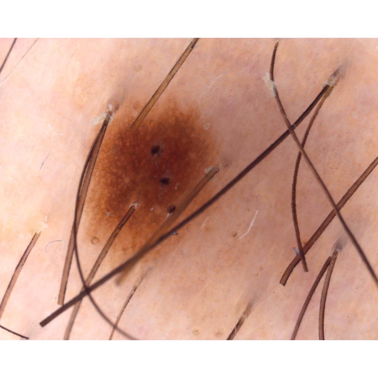 Dermatoscopio Mic-Fi - WI-FI/USB con filtro polarizzato