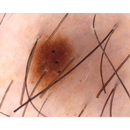 Dermatoscopio Mic-Fi - WI-FI/USB con filtro polarizzato