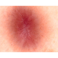 Dermatoscopio Mic-Fi - WI-FI/USB con filtro polarizzato e Software