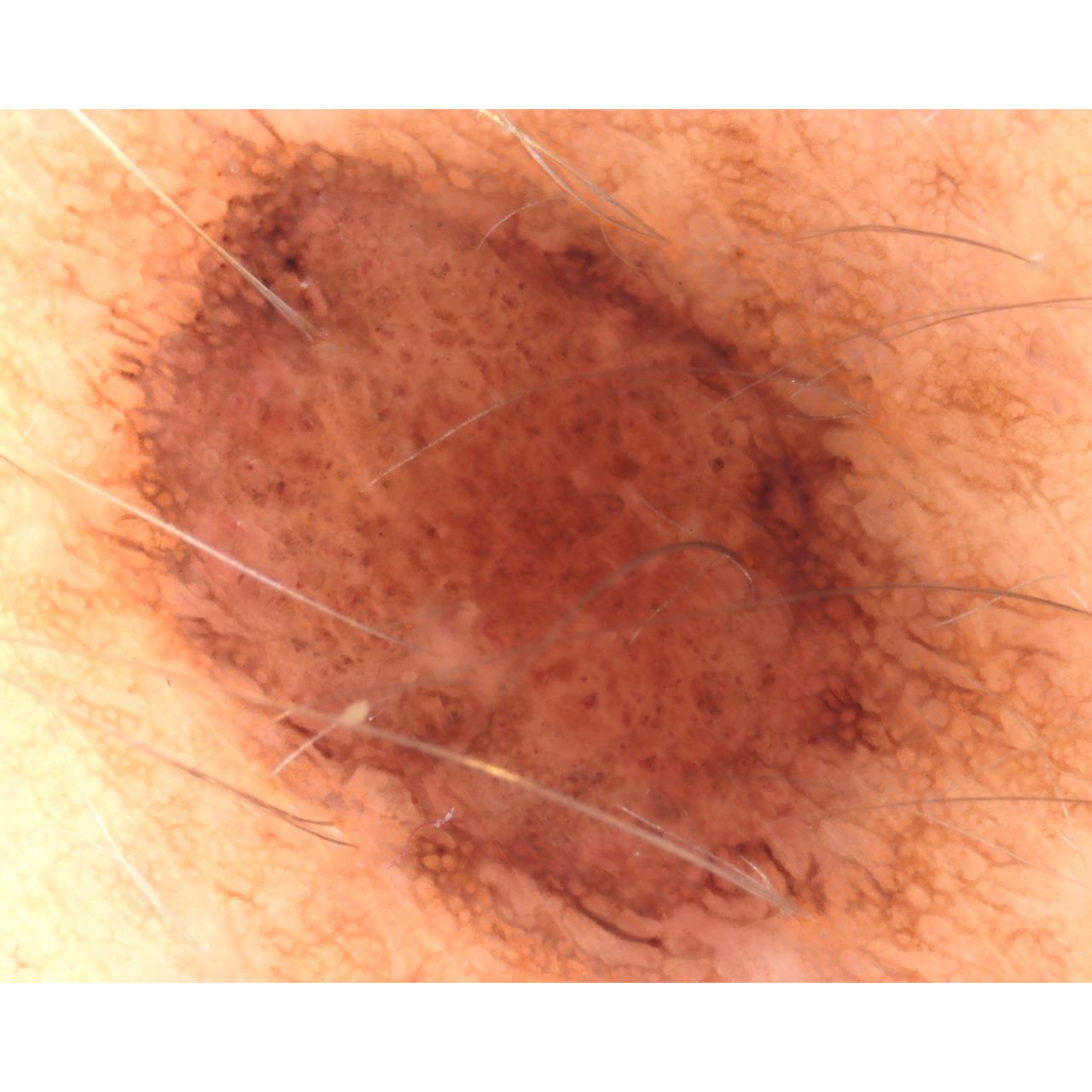 Dermatoscopio Mic-Fi - WI-FI/USB con filtro polarizzato e Software