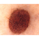 Dermatoscopio Mic-Fi - WI-FI/USB con filtro polarizzato e Software