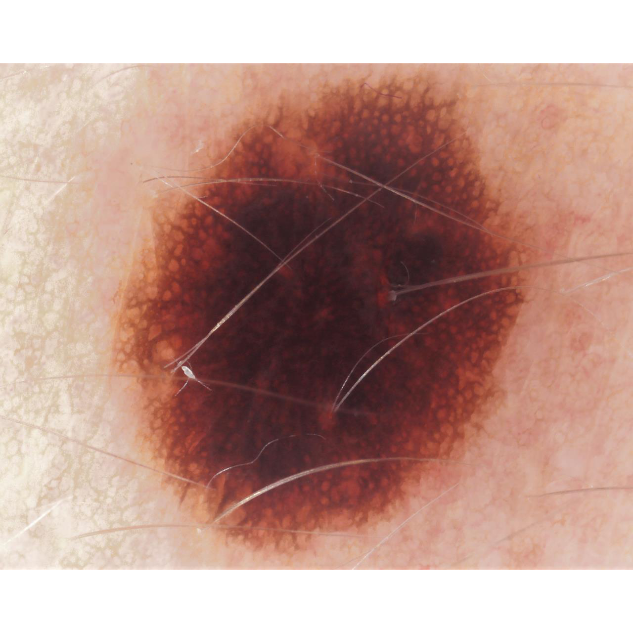 Dermatoscopio Mic-Fi - WI-FI/USB con filtro polarizzato e Software