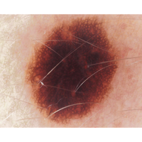 Dermatoscopio Mic-Fi - WI-FI/USB con filtro polarizzato e Software