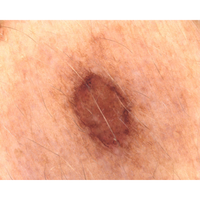 Dermatoscopio Mic-Fi - WI-FI/USB con filtro polarizzato e Software