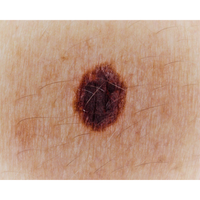 Dermatoscopio Mic-Fi - WI-FI/USB con filtro polarizzato e Software