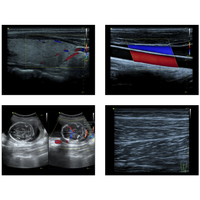 Ecografo Color-Doppler portatile VINNO 5 con Sonda Lineare e Phased-Array