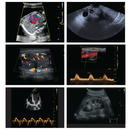 Ecografo Color-Doppler portatile VINNO A6 con Sonda Lineare e Phased-Array