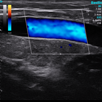 Ecografo Color-Doppler palmare SonoEye P2 con Sonda Lineare 7,5 MHz
