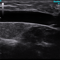 Ecografo Color-Doppler palmare SonoEye P2 con Sonda Lineare 7,5 MHz