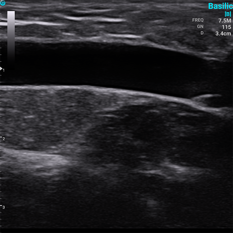 Ecografo Color-Doppler palmare SonoEye P2 con Sonda Lineare 7,5 MHz