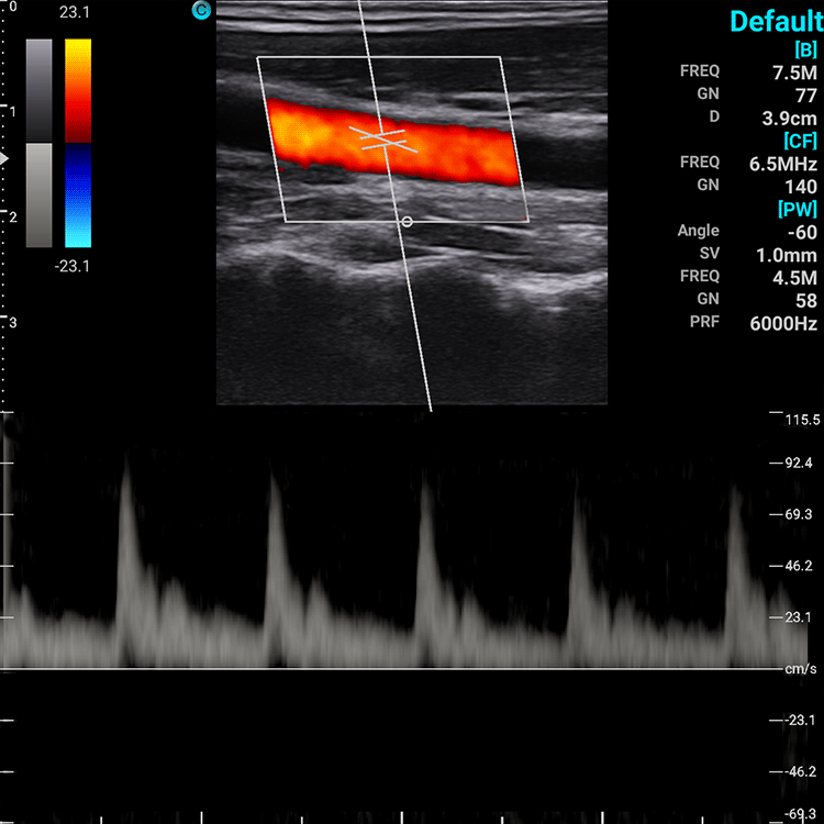 Ecografo Color-Doppler palmare SonoEye P2 con Sonda Lineare 7,5 MHz