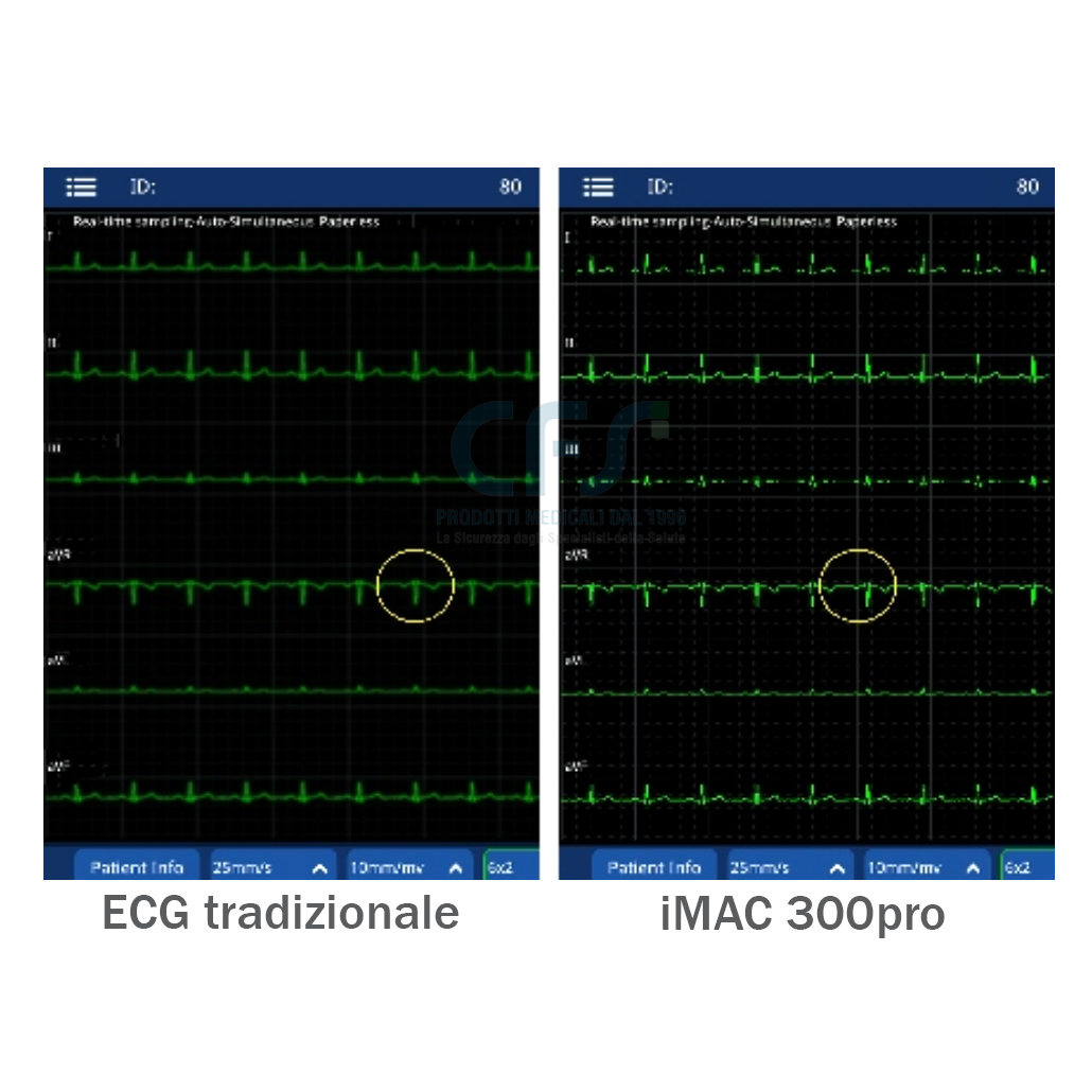 ECG Zoncare iMAC 300pro - Elettrocardiografo a 3 canali Interpretativo Glasgow