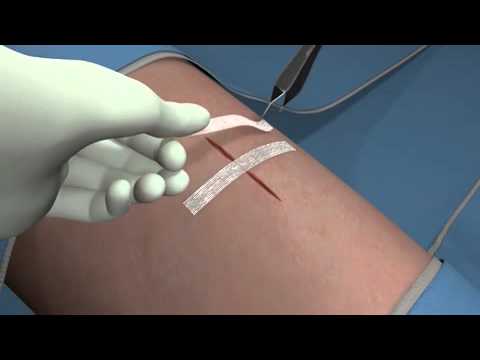 3M Steri-Strip mm 6 x 100 - R1546 (conf. 10 pz.)