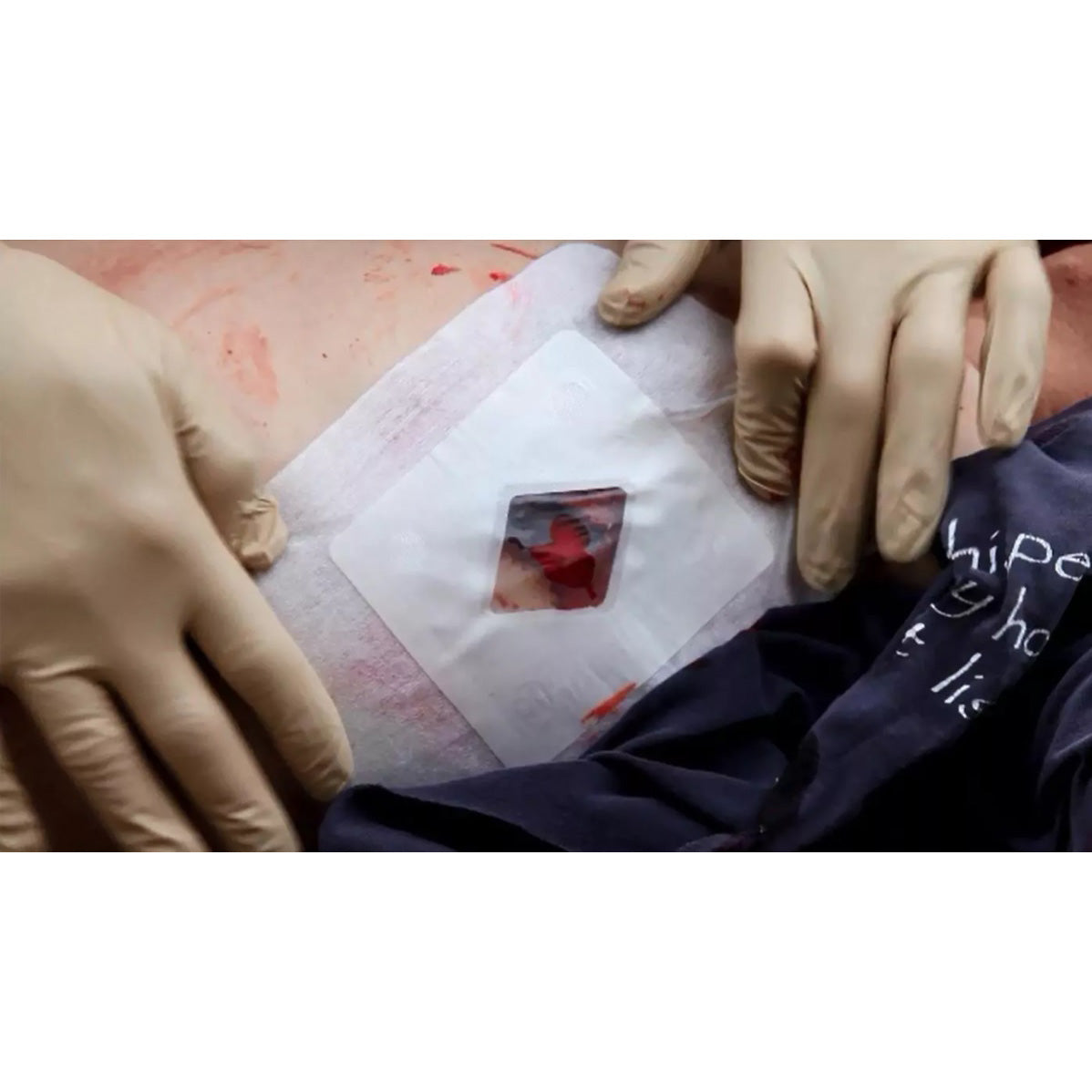 Cerotto per pneumotorace esterno Russell Chest Seal®